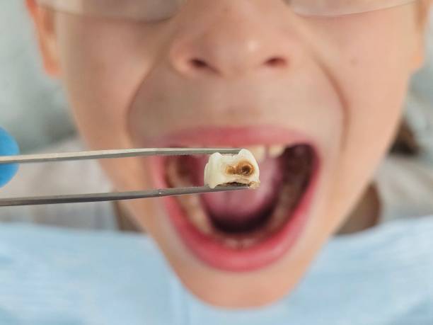 Best Broken or Cracked Tooth Emergency Dentist in Lakeland Village, CA